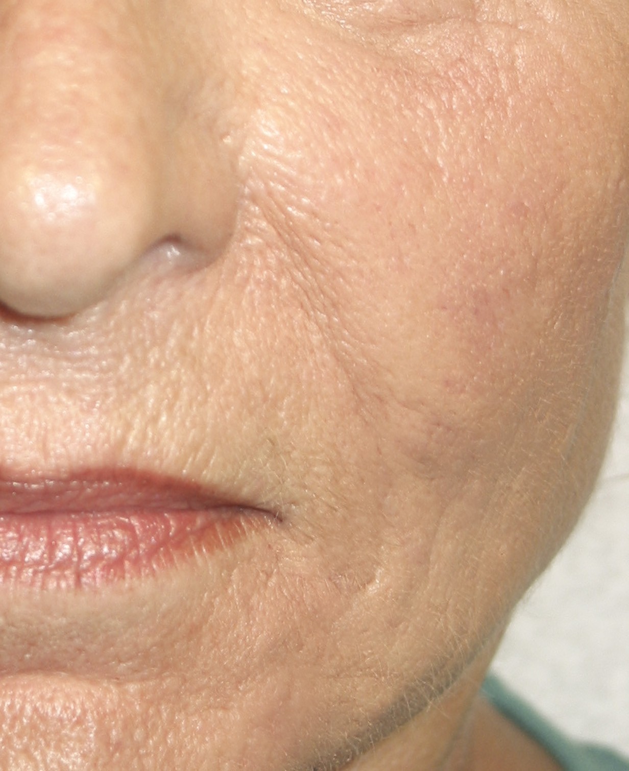 Neuropathie breedtegraad George Hanbury Acne) Littekens in uw gezicht verwijderen met Hyaluronzuur