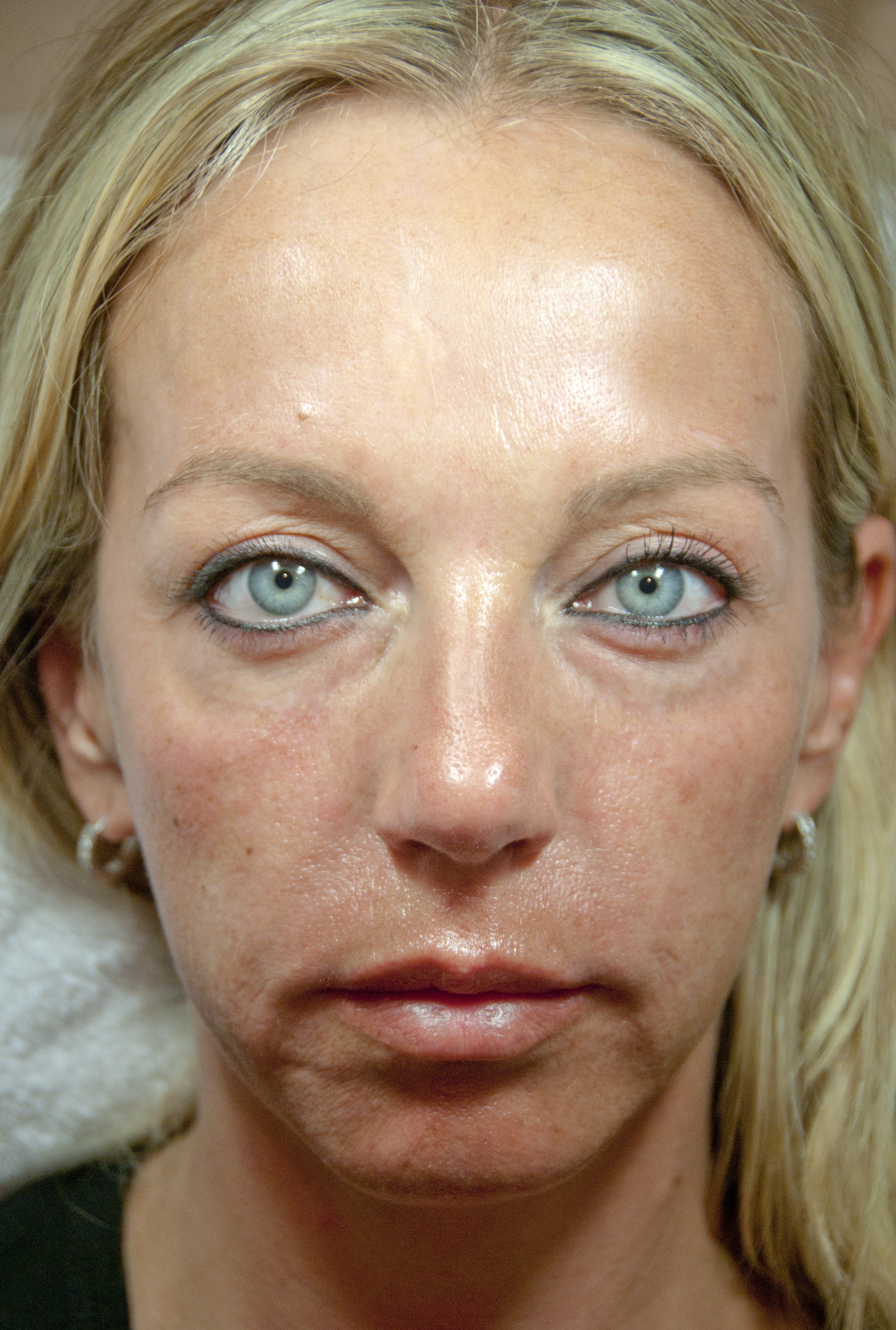 Belangrijk nieuws Ook Romantiek Rimpels verwijderen in uw gezicht zonder Botox of operatie met hyaluronzuur