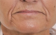 Voor foto van verwijderen  van rimpels en lifting mondhoeken met hyaluronzuur | lippen