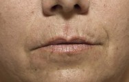 Voor foto correctie littekens en rimpels met hyaluronzuur  | lippen