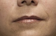 na foto correctie littekens en rimpels met hyaluronzuur | lippen
