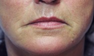 Voor foto van rimpelcorrectie en lifting mondhoeken met hyaluronzuur | lippen