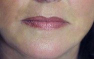 na foto van rimpelcorrectie en lifting mondhoeken met hyaluronzuur | lippen