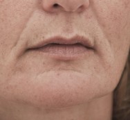 Voor foto van de correctie mondhoeken en neuslippenplooi met hyaluronzuur | diepe neuslippenplooi aanpakken