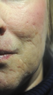 Voor foto van correctie van acne littekens met hyaluronzuur | acné & littekens  