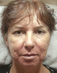 Voor foto van de behandeling littekens verwijderen en liquid facelift met hyaluronzuur | acné & littekens  