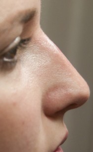 na de correctie van neus met hyaluronzuur | neus