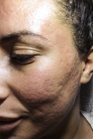 Voor FOTO VAN LITTEKENS | acné & littekens  