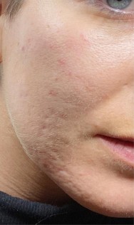 Voor littekencorrectie met hyaluronzuur | acné & littekens  
