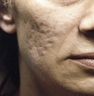 Voor foto van littekens verwijderen van tengevolge van acne | acné & littekens  