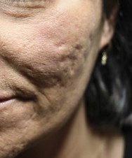 Voor Littekencorrectie met hyaluronzuur | acné & littekens  