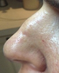 Voor correctie neus met hyaluronzuur | neus