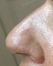 na correctie neus met hyaluronzuur | acné & littekens  