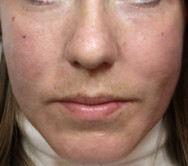 na Correctie van littekens met hyaluronzuur | acné & littekens  